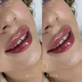 Powiększanie UST PROMOCJA 350zł/ Likwidacja zmarszczek