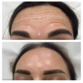 Modelki/ modele na botoks Olsztyn